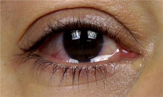چشم؛‌ دریچه‌ای برای تشخیص بسیاری از بیماری‌ها