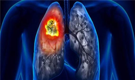 ژن‌هایی که عامل مرگ زودرس افراد مبتلا به سرطان ریه هستند